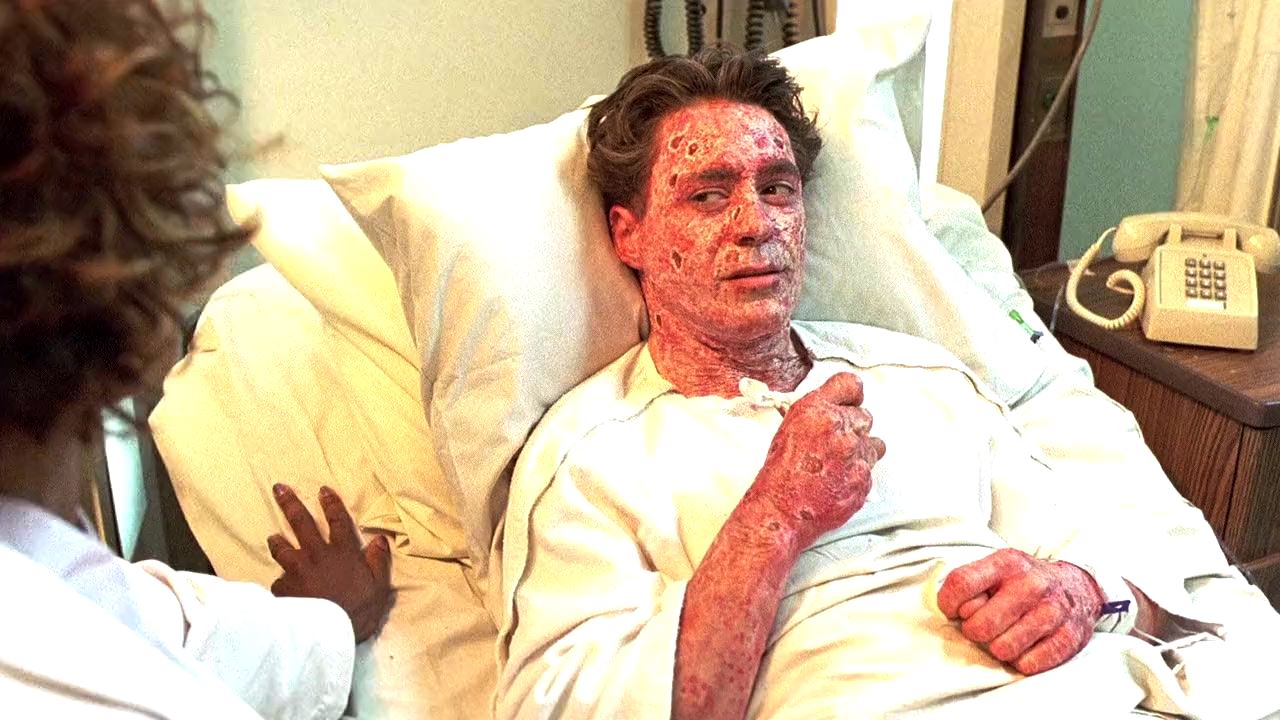 Robert Downey Jr hospitalied with psoriasis in The Singing Detective (2003)